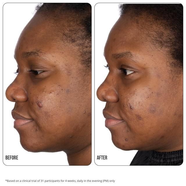 Nip+Fab Retinol Fix Blemish Treatment Gel 10% 15ml